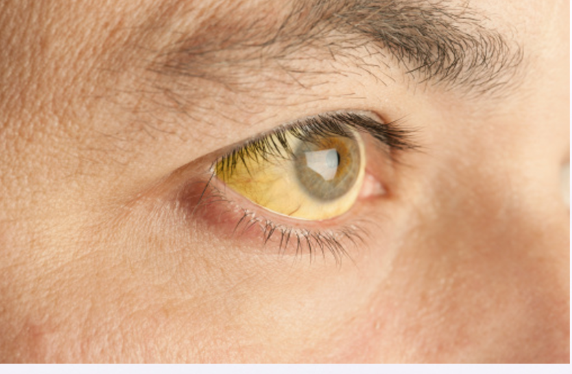 take-these-things-in-jaundice पीलिया हो तो खानपान में अपनाएं ये चीजें
