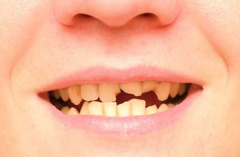 dental जरूरी खबर : दांत काले होने के साथ टूटने लगेंगे अगर पानी में इस चीज की मात्रा है ज्यादा