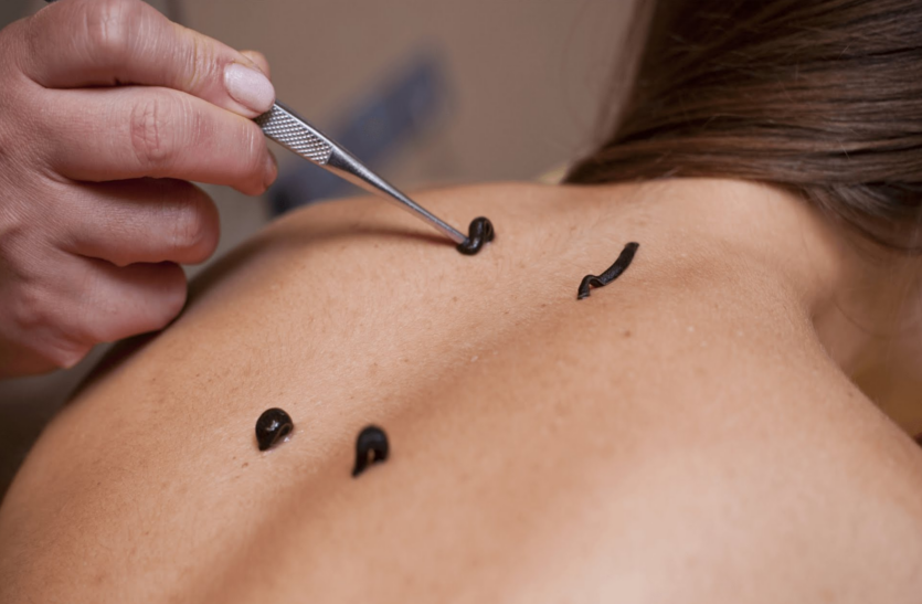 know-about-leech-therapy 'लीच थैरेपी' से शरीर का दूषित रक्त दूर कर किया जाता है कई बीमारियों का इलाज