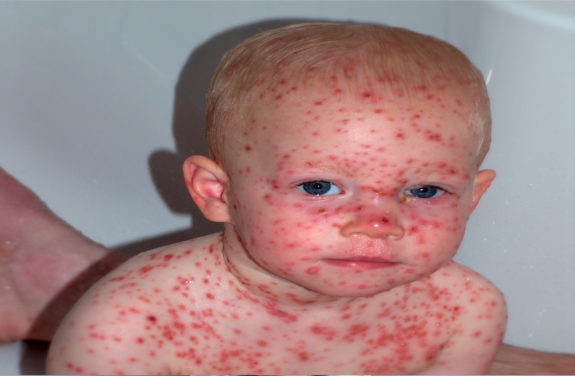treat-chicken-pox चिकनपॉक्स का उपचार करें, झाड़-फूंक के चक्कर में न पड़ें, जानें ये खास बातें