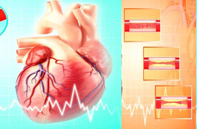 learn-about-angioplasty जानें एंजियोप्लास्टी के बारे में, क्या हैं इसके फायदे