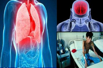 bones-stomach-brain-genitalia-can-also-be-tuberculosis bones-stomach-brain-genitalia-can-also-be-tuberculosis
