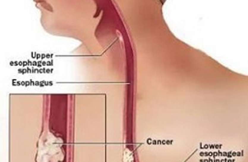food pipe cancer मानसिक तनाव ने दे दिया भोजन की नली में कैंसर