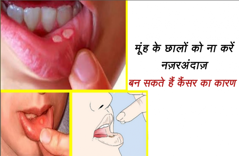 health news मूंह के छालों को ना करें नज़रअंदाज़, बन सकते हैं कैंसर का कारण, जाने कैसे