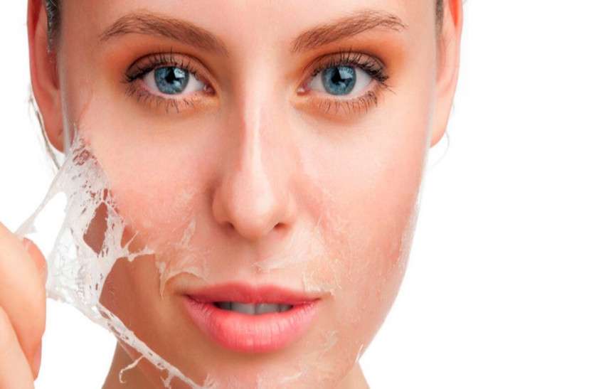 Chemical Peeling जानें क्या है केमिकल पीलिंग और क्यों होती है इसकी जरूरत