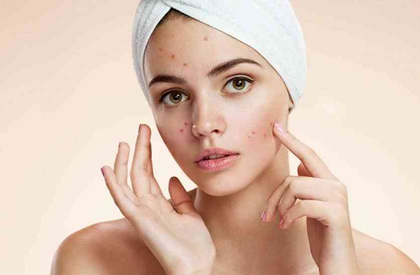 acne खून में गर्मी या शीत बढऩे से होते हैं ये रोग