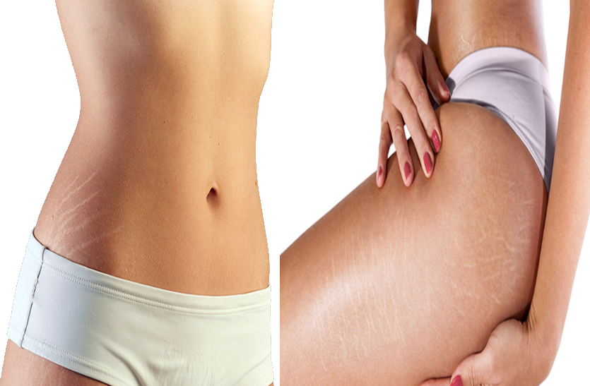 stretch marks स्ट्रेच माक्र्स है तो अपनाएं ये उपाय