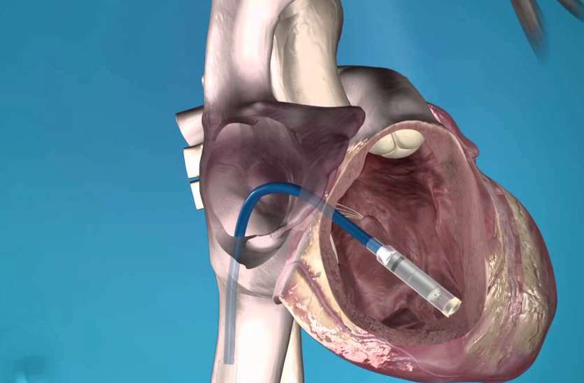 Pacemaker दुनिया का सबसे छोटा पेसमेकर लगाकर दी नई जिंदगी