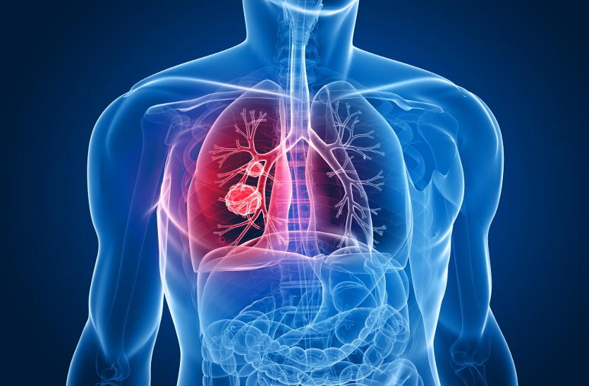 cancer एक्सपर्ट इंटरव्यू: तम्बाकू से करें तौबा, दूर रहेगा कैंसर