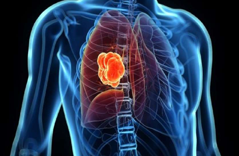 Cancer किसी को भी हो सकती है ये खतरनाक बीमारी, भूलकर भी न करे इन लक्षणों को इग्नोर