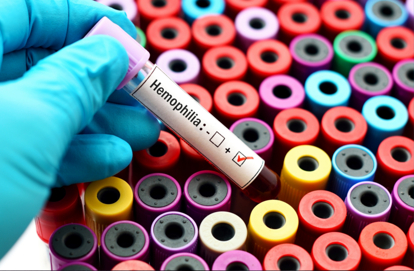 hemophilia-problem-is-caused-by-genetic-factors आनुवांशिक कारणों से होती है हीमोफीलिया की समस्या