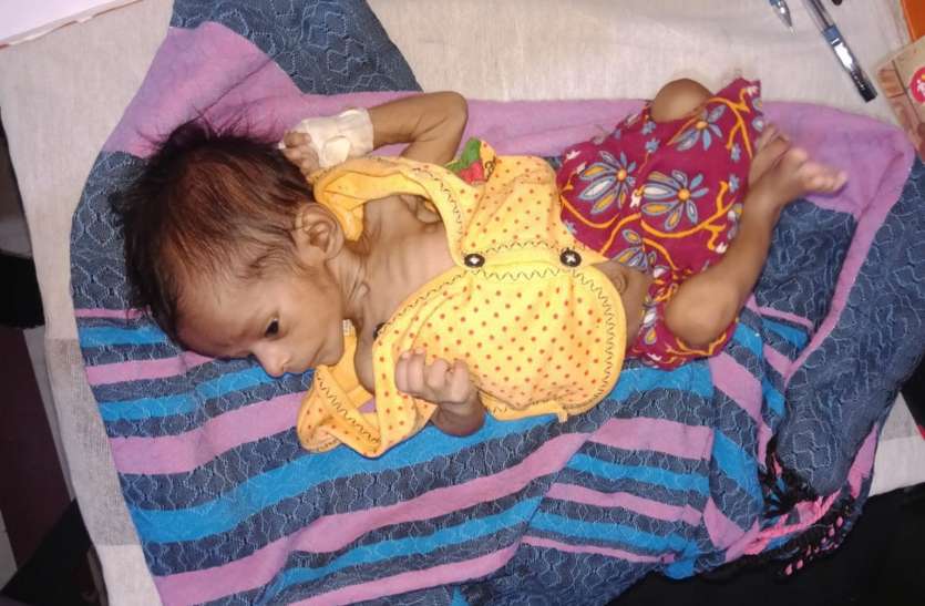 Mother brought malnourished child to NRC hospital कुपोषित बच्चे को एनआरसी नहीं अस्पताल लेकर पहुंची मां