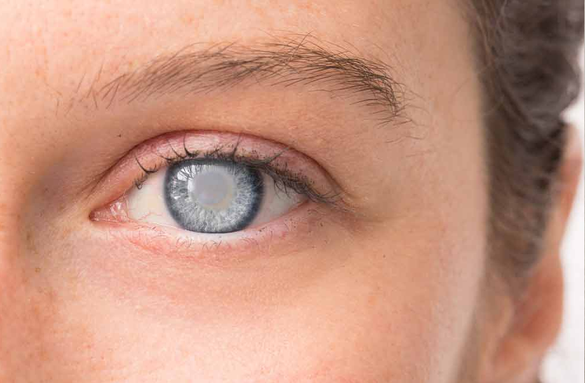 causes-of-cataract इस कारण से भी आंखों में होता है मोतियाबिंद