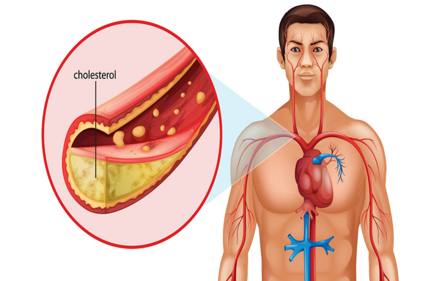 bad-cholesterol-is-the-enemy-of-your-health आपकी सेहत का दुश्मन हैं बैड कोलेस्ट्रॉल, जानें इसके बारे में