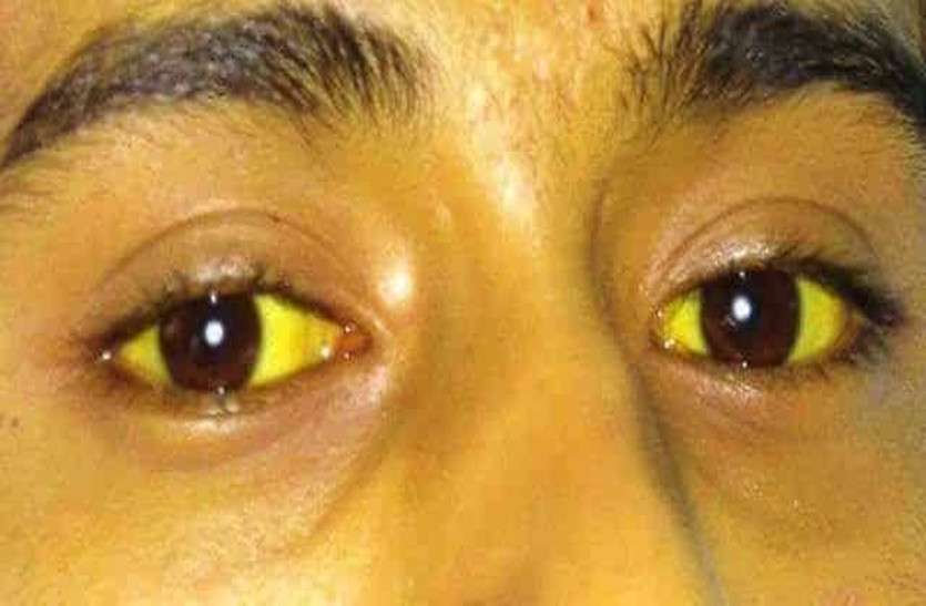 jaundice पीलिया ने दी दस्तक, 12 बच्चे बीमार, सभी एक ही कॉलोनी के रहने वाले, मचा हड़कंप