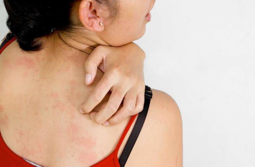 itching यूनानी चिकित्सा: जब हो खाज की समस्या तो यूनानी में जानें ये हैं इलाज