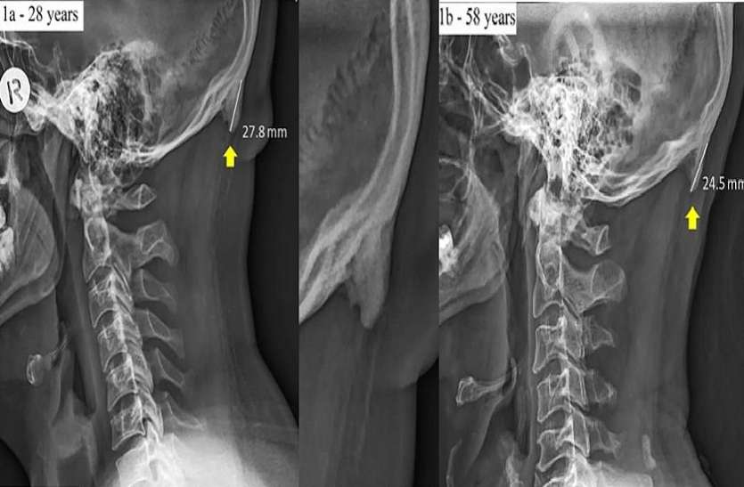 human skeleton is changing due to excess use of mobile phones मोबाइल पर बिताते हैं ज्यादा समय तो हो जाएं सावधान! सिर के पीछे निकल सकती 'नई' हड्डी