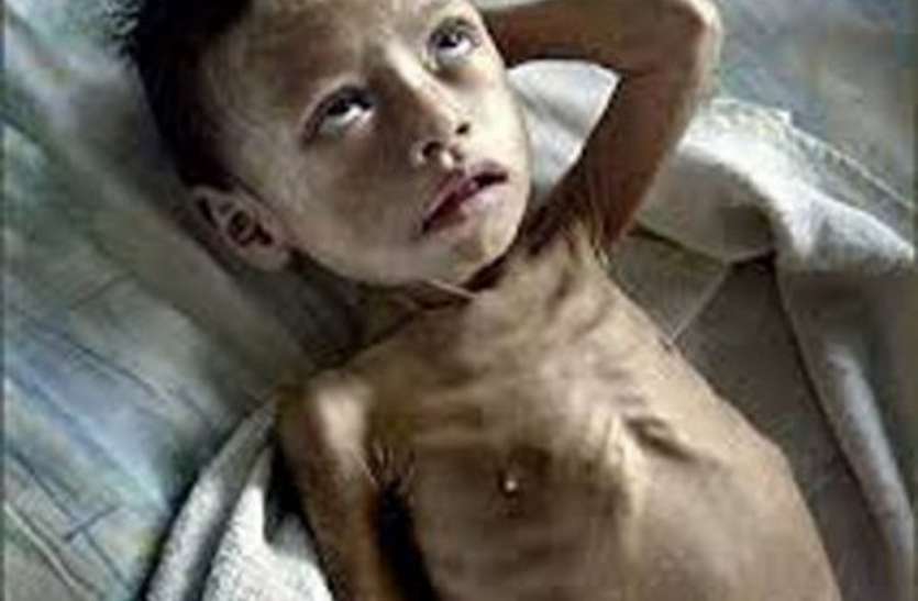 Thousands of malnourished children in CM's home district, read full news सीएम के गृह जिले में हजारों की संख्या में कुपोषित बच्चे, पढ़ें पूरी खबर