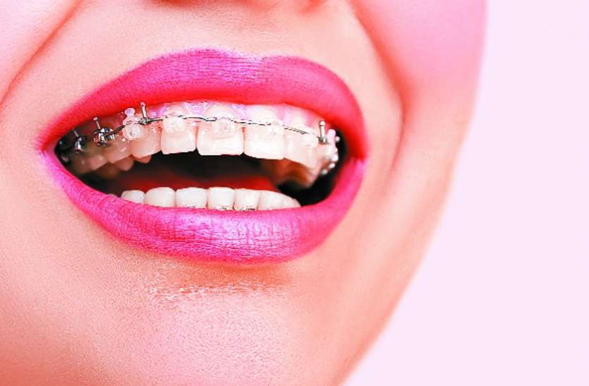 braces जब हो ओरल प्रॉब्लम तो ये उपाय करने से मिलेगा लाभ