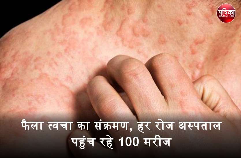 banswara Skin infection : बांसवाड़ा में फैला त्वचा का संक्रमण, हर रोज अस्पताल पहुंच रहे 100 मरीज