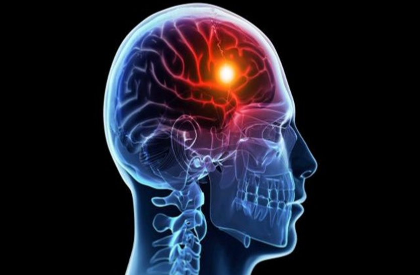 Brain Stroke: जानिए क्यों होता है ब्रेन स्ट्रोक, कैसे करें पहचान और उपचार वर्ल्ड स्ट्रोक डे: कोरोना मरीजों के लिए लकवे का अटैक और भी घातक