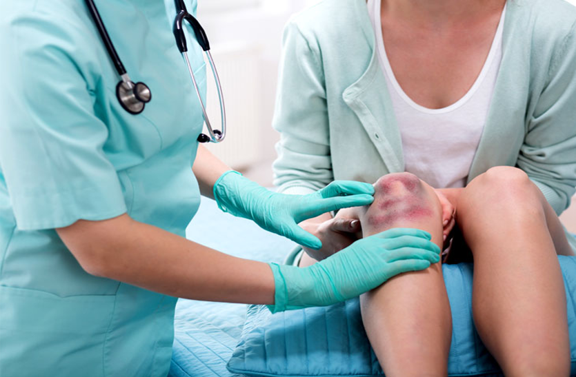 platelets-count-blue-rashes-on-body-causes-symptoms-and-treatment Platelets Count: शरीर पर दिखाई दें एेसे चकत्ते तो हो जाएं सावधान