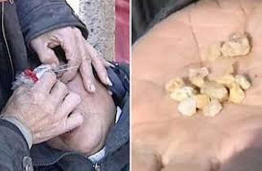 Patrika Pic नन्ही बच्ची की आंखों से गिर रहे थे पत्थर