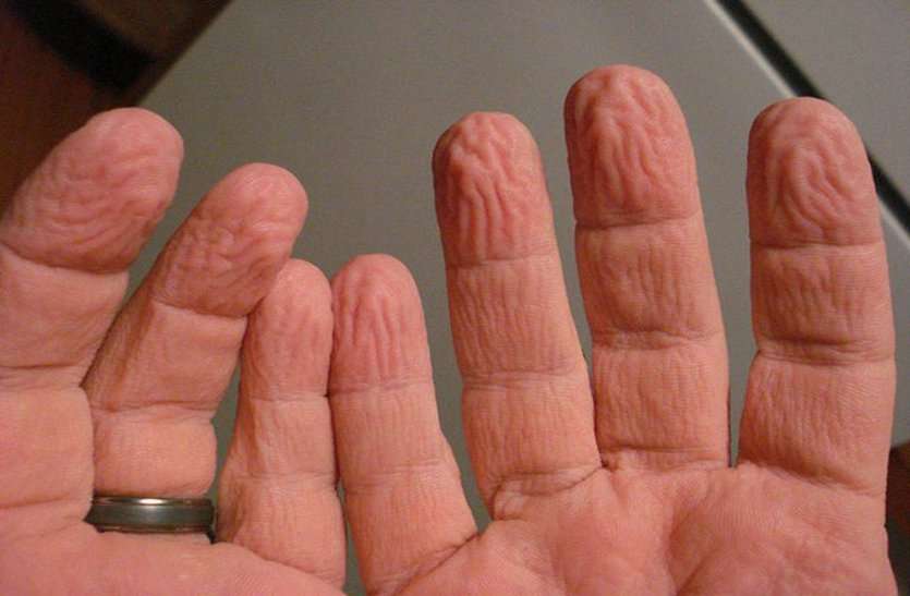 finger shrinking news hindi