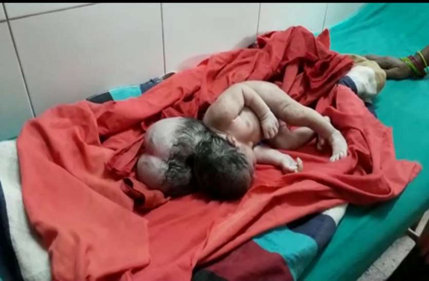 Three headed baby एटा में महिला ने तीन सिर की बच्ची को दिया जन्म