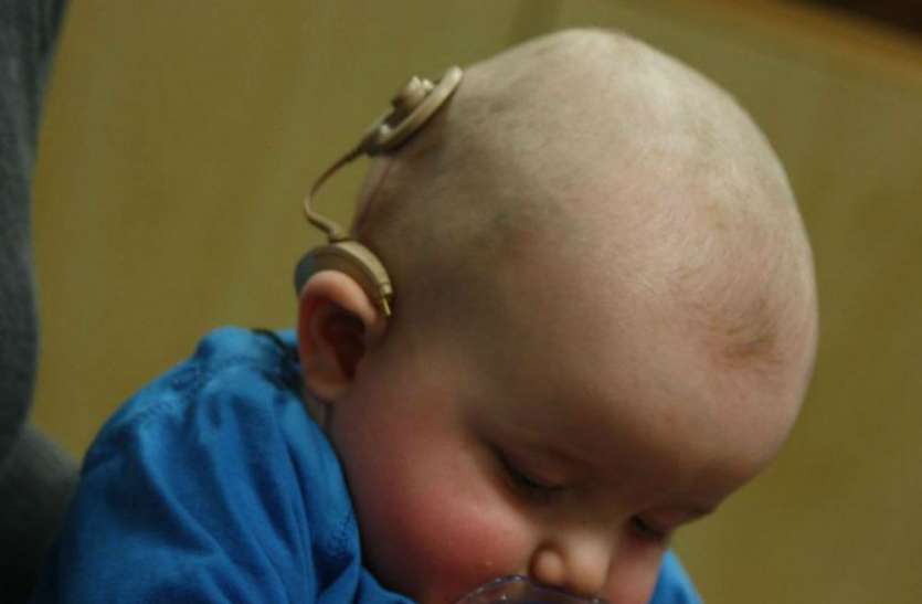Cochlear implant Surgery Cochlear implant Surgery योगी सरकार छह लाख रुपये का ऑपरेशन फ्री में करा रही, नोट करें तारीख