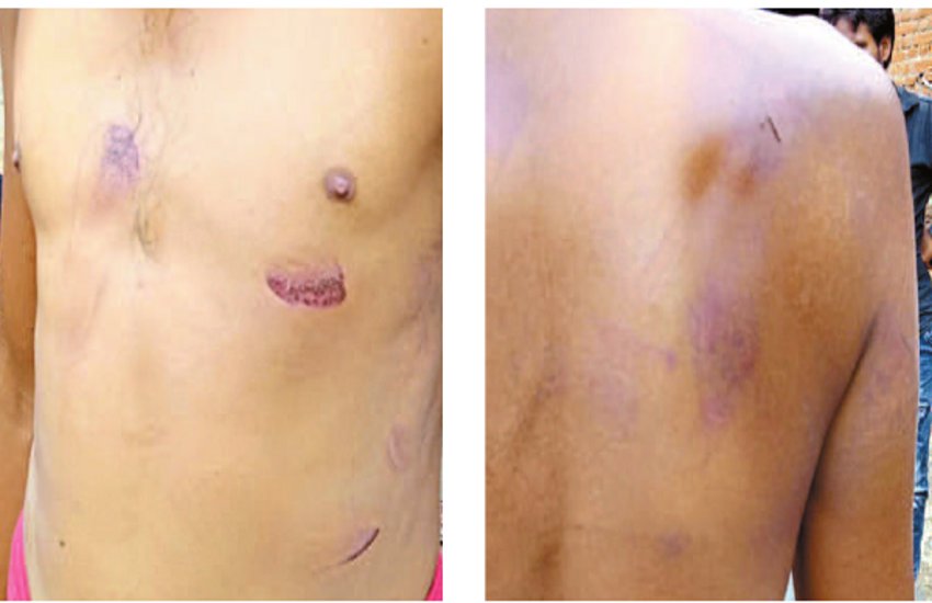 Three accused arrested for brutalizing children बच्चों को बेरहमी से पीटने वाले तीन आरोपी गिरफ्तार