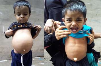 rare Gaucher's disease five case found in child churu rajasthan सावधान ! विश्व की दुर्लभ और जानलेवा बीमारी की चपेट में आ रहे बच्चे, ये हैं इसके लक्षण