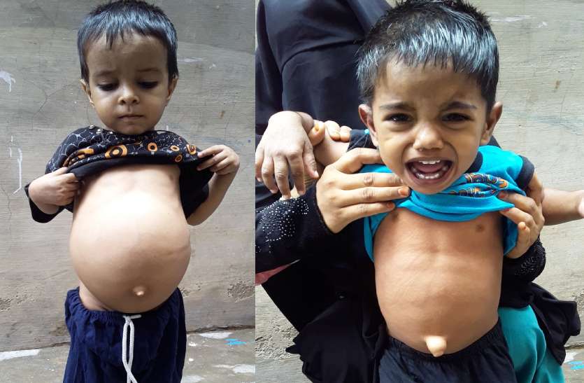 Rare Gaucher's Disease Five Case Found : विश्व की दुर्लभ और जानलेवा बीमारी ‘गोचर डिजीज’ से अपना चूरू शहर भी अछूता नहीं है। यह बीमारी गिने-चुने लोगों में पाई जाती है। सावधान ! विश्व की दुर्लभ और जानलेवा बीमारी की चपेट में आ रहे बच्चे, ये हैं इसके लक्षण