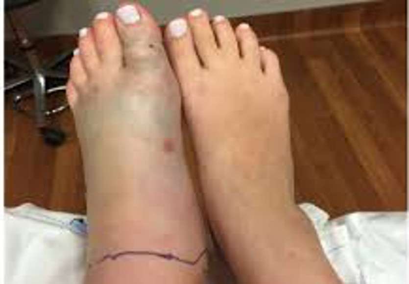 Snake bite women