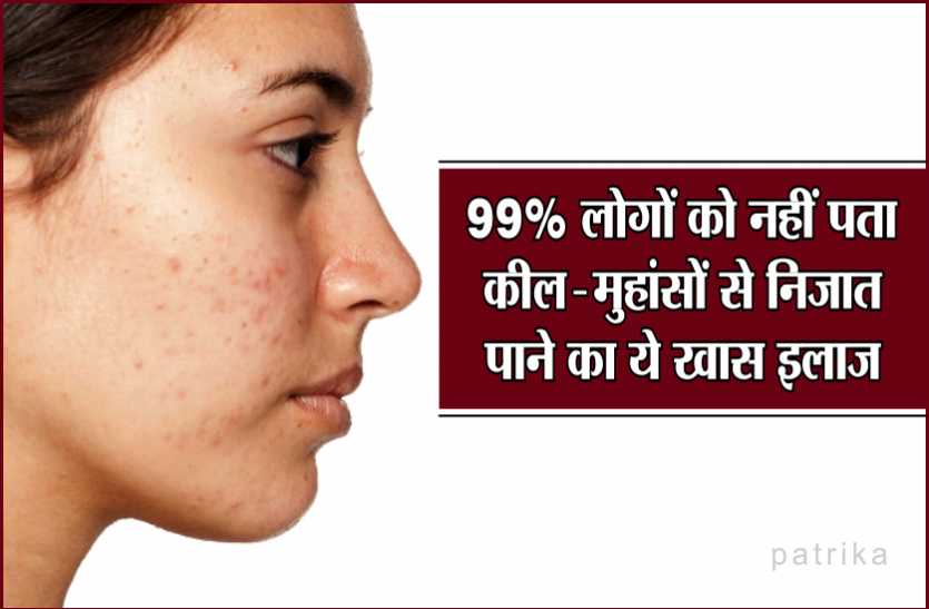 Acne Problem And Its Natural Treatment At Home - Acne problem Solution : 99% लोगों को नहीं पता कील-मुहांसों से निजात पाने का ये खास इलाज, चेहरा हो जाएगा कोमल और चमकदार! |