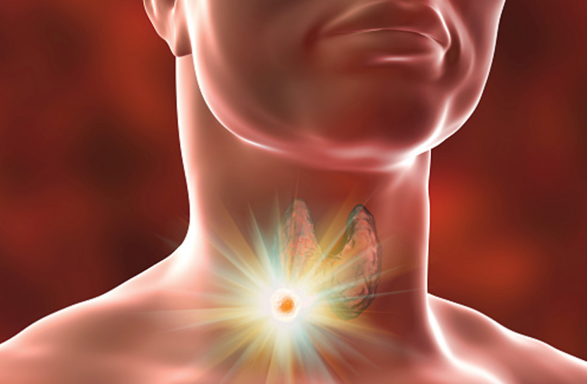 throat cancer Throat cancer - गले में जलन, दर्द, निगलने में समस्या हाे ताे अलर्ट हाे जाएं