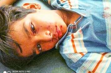 Explosion while lighting bulb mobile battery, rashes in baby's palm Explosion while lighting bulb mobile battery, rashes in baby's palm