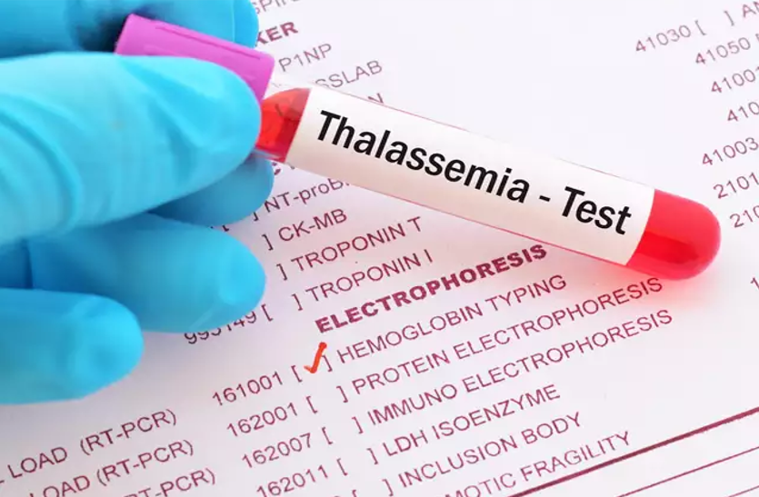 know-about-thalassemia बच्चे में कमजोरी, थकान और वजन का न बढ़ना हो सकते हैं इस बीमारी के संकेत