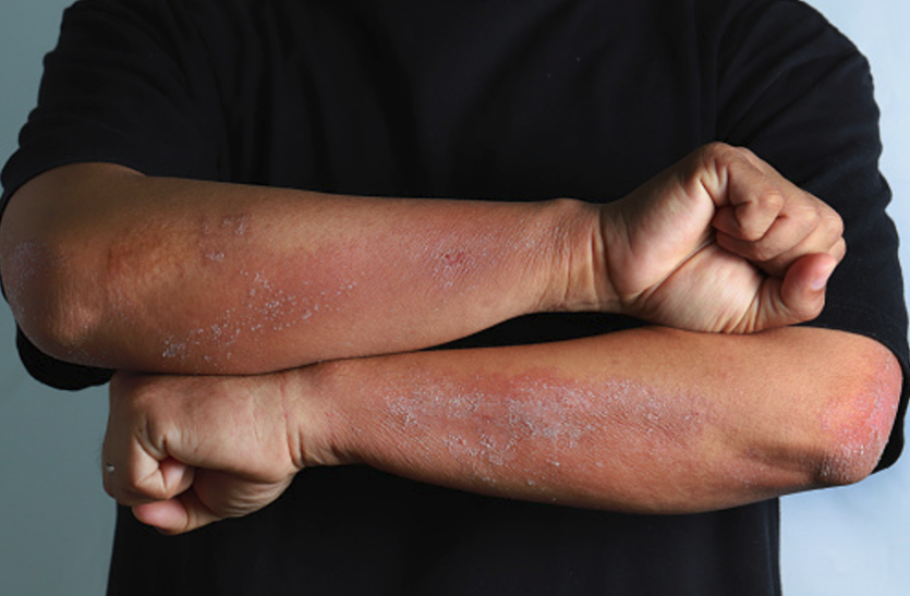cellulitis त्वचा में सूजन, लाल होना है सेल्यूलाइटिस का संकेत