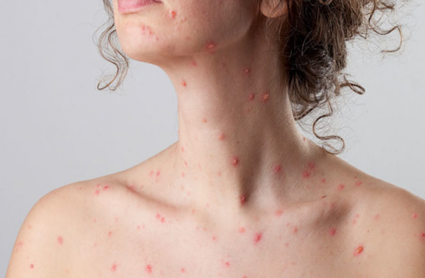 keep-these-things-in-mind-if-you-get-chickenpox चिकनपॉक्स निकले तो रखें इन बातों का ध्यान, जानें ये खास बातें
