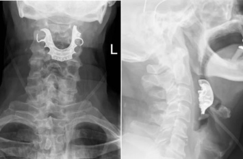 dentures went missing after surgery doctor found them lodged in throat शख्स के गले से निकल रहा था खून, डॉक्टरों ने कैमरा डालकर देखा तो उड़े होश