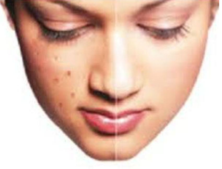 Pimple Free face know Expert opinion Beauty Tips कील-मुंहासों से हैं परेशान, तो इन घरेलू उपाय से मिलेगी बड़ी राहत, दो दिन में पायें रिजल्ट