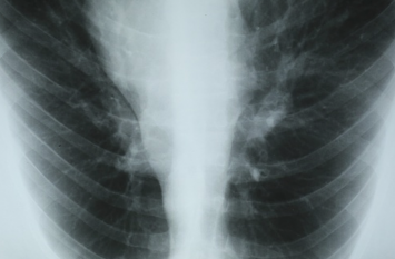 COPD - Symptoms, causes and treatment सीओपीडी में घटती है फेफड़ों की ताकत, थकने लगता है मरीज