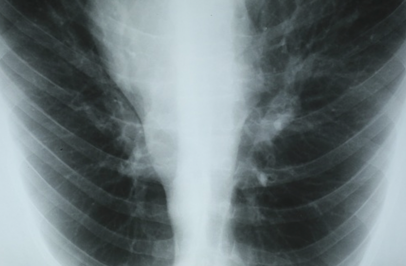 Chronic Obstructive Pulmonary Disease (COPD) सीओपीडी में घटती है फेफड़ों की ताकत, थकने लगता है मरीज
