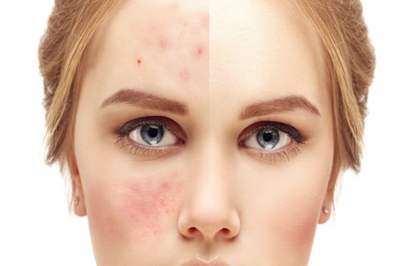 acne हाॅॅॅमाेनल बदलाव के कारण होते हैं मुहांसे, एेसे करें बचाव