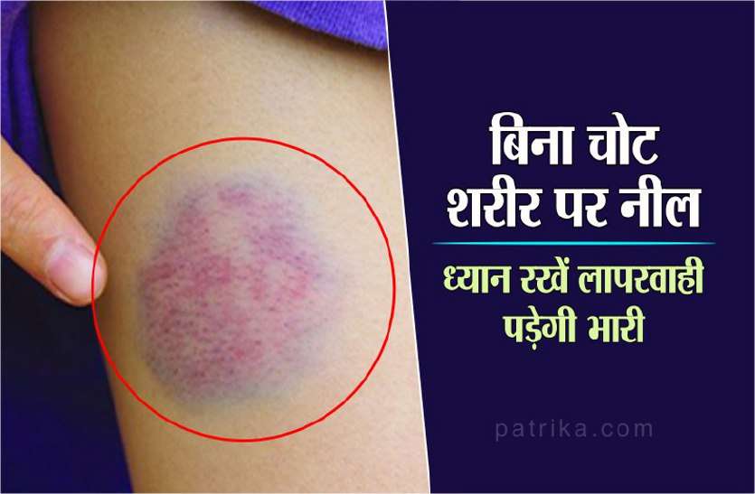 body signals आपका शरीर भी देता है बीमारियों का संकेत: जानिये कैसे बिना चोट के पड़ जाती है नील, ना बरतें लापरवाही