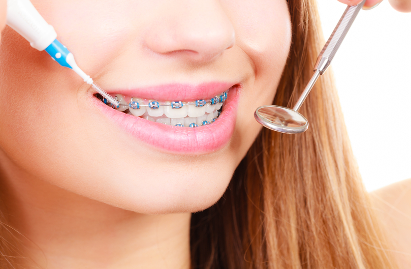 Braces दांतों में हो ये समस्या तो लें एेसी डाइट, जानें इसके बारे में