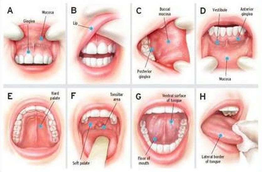 oral cancer