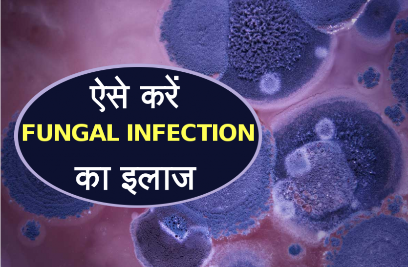 Fungal Infection treatment मॉनसून में Fungal Infection से हैं परेशान, एक बार ज़रूर जान लें ये घरेलू उपचार
