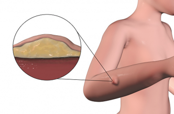 Lipoma: fat bumps without pain, do not ignore लाइपोमा: बिना दर्द की चर्बीवाली गांठें, न करें नजरअंदाज